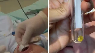 מקרה מסוכן הסתיים בנס: פעוט שאף לגו ושרד הודות לערנות האם והצוות הרפואי