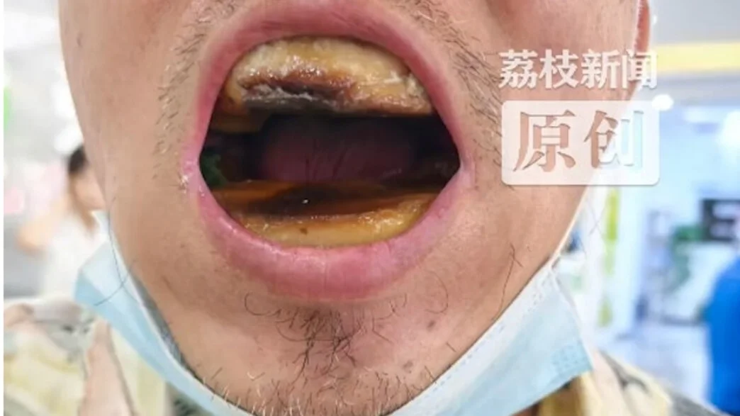 הזול יצא יקר: שיניים תותבות ב־5 יואן הפכו לסיוט רפואי