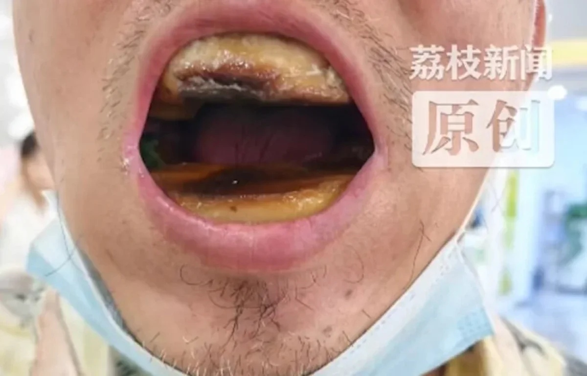 הזול יצא יקר: שיניים תותבות ב־5 יואן הפכו לסיוט רפואי