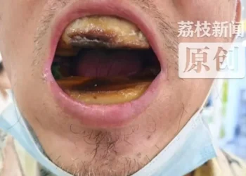 הזול יצא יקר: שיניים תותבות ב־5 יואן הפכו לסיוט רפואי