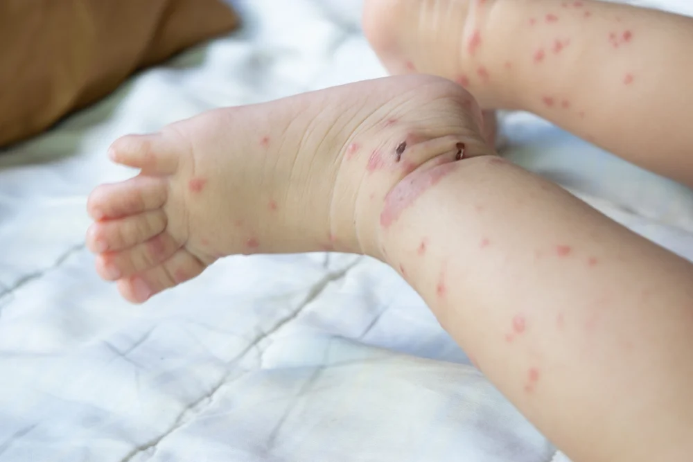 "הילד לא חוסן  ועכשיו נלחם על חייו": חצבת חוזרת ומסכנת תינוקות בישראל