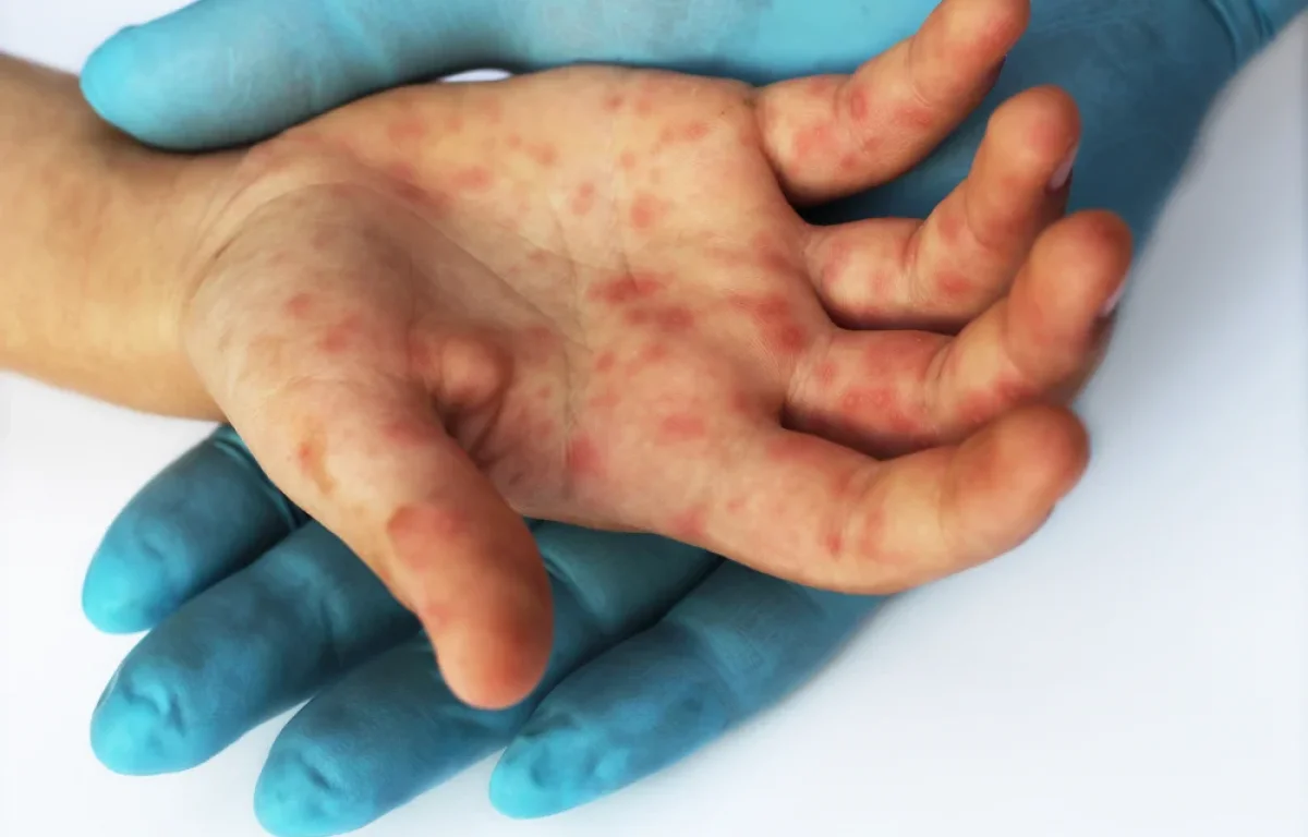 פעוט מירושלים נפטר מחצבת: שלושה מקרי מוות מתחילת ההתפרצות