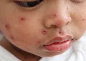 החצבת גובה מחיר כבד: תינוק בן שנה וחצי מירושלים מת מהמחלה 