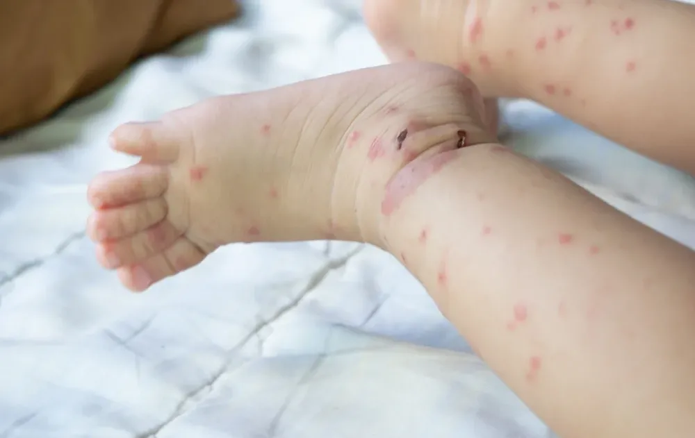 פעוטה בת שנתיים מתה מסיבוכי חצבת, מניין הקורבנות עלה ל-8 פעוטה בת שנתיים מתה מסיבוכי חצבת, מניין הקורבנות עלה ל-8