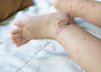 פעוטה בת שנתיים מתה מסיבוכי חצבת, מניין הקורבנות עלה ל-8