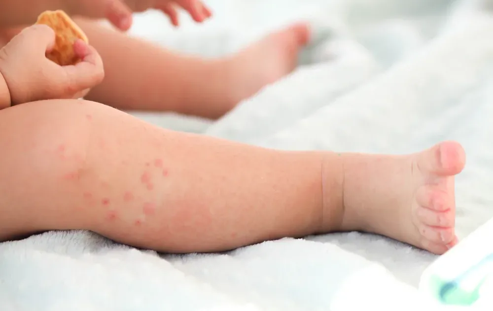 גל החצבת גובה קורבן נוסף: פעוטה מתה מהמחלה הקטלנית