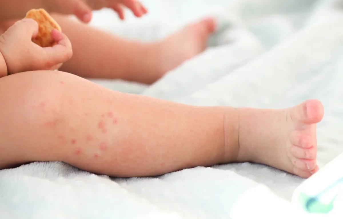 גל החצבת גובה קורבן נוסף: פעוטה מתה מהמחלה הקטלנית