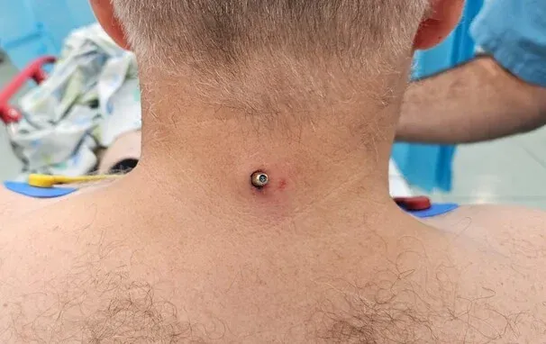 "ברוך ה' שנשארתי בחיים": תושב מעלות נורה בצוואר במהלך הליכה באגם "ברוך ה' שנשארתי בחיים": תושב מעלות נורה בצוואר במהלך הליכה באגם