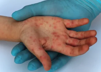 התפרצות החצבת: שני רופאים נדבקו בבית החולים איכילוב