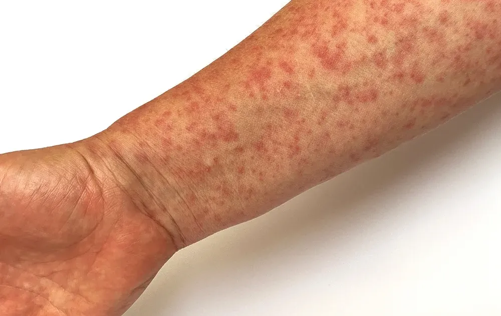 התרעה חמורה: חצבת התפשטה בתחבורה הציבורית ובאירוע בירושלים - האם הייתם שם?