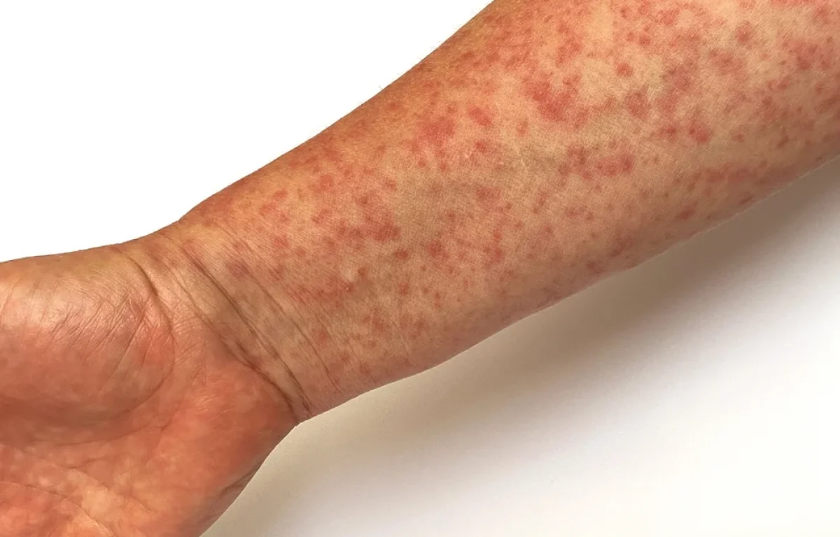 התרעה חמורה: חצבת התפשטה בתחבורה הציבורית ובאירוע בירושלים - האם הייתם שם? התרעה חמורה: חצבת התפשטה בתחבורה הציבורית ובאירוע בירושלים - האם הייתם שם?