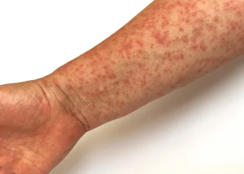 התרעה חמורה: חצבת התפשטה בתחבורה הציבורית ובאירוע בירושלים - האם הייתם שם? התרעה חמורה: חצבת התפשטה בתחבורה הציבורית ובאירוע בירושלים - האם הייתם שם?