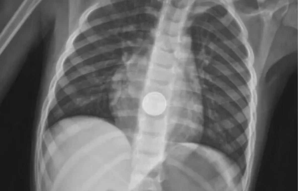 פעוט בן 3 בלע סוללה זעירה ועבר ניתוח חירום להצלת חיים פעוט בן 3 בלע סוללה זעירה ועבר ניתוח חירום להצלת חיים