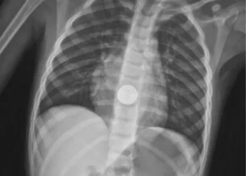 פעוט בן 3 בלע סוללה זעירה ועבר ניתוח חירום להצלת חיים פעוט בן 3 בלע סוללה זעירה ועבר ניתוח חירום להצלת חיים