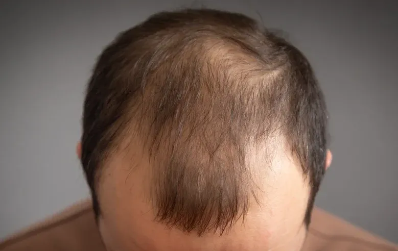 לא צריך תוספים: המאכלים שבאמת עוזרים נגד נשירת שיער