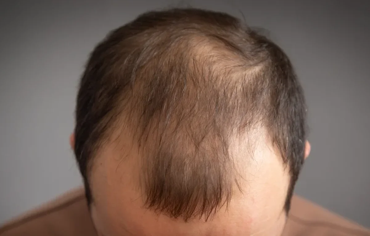 לא צריך תוספים: המאכלים שבאמת עוזרים נגד נשירת שיער