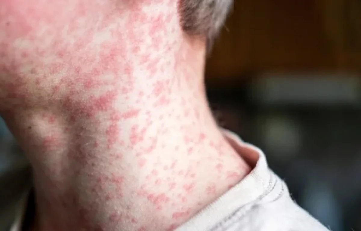 "מגפה של אדישות": תשעה ילדים מתו - והחצבת חוזרת לישראל בעוצמה שלא נראתה שנים