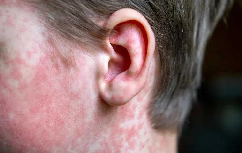 התפשטות החצבת: חיפה מצטרפת לרשימת מוקדי ההתפרצות - חמישה מאושפזים מהחברה החרדית