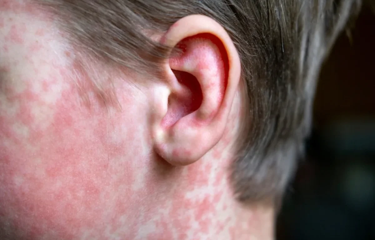 התפשטות החצבת: חיפה מצטרפת לרשימת מוקדי ההתפרצות - חמישה מאושפזים מהחברה החרדית