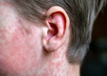 התפשטות החצבת: חיפה מצטרפת לרשימת מוקדי ההתפרצות - חמישה מאושפזים מהחברה החרדית