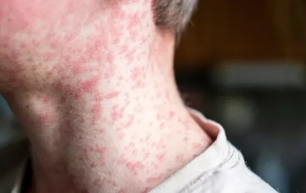 טרגדיה בירושלים: פעוט בן שנה נפטר מסיבוכי חצבת