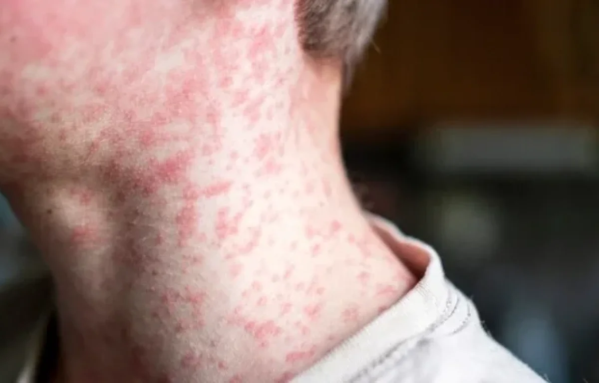 טרגדיה בירושלים: פעוט בן שנה נפטר מסיבוכי חצבת