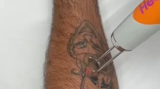 הסרת קעקוע מתוך תשובה - רגע שמדבר בלי מילים