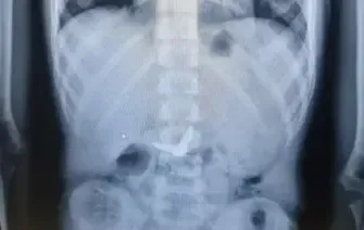 נס רפואי: ילד בן 11 בלע מספריים – והם נפלטו מגופו ללא כל ניתוח נס רפואי: ילד בן 11 בלע מספריים – והם נפלטו מגופו ללא כל ניתוח