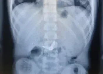 נס רפואי: ילד בן 11 בלע מספריים – והם נפלטו מגופו ללא כל ניתוח נס רפואי: ילד בן 11 בלע מספריים – והם נפלטו מגופו ללא כל ניתוח