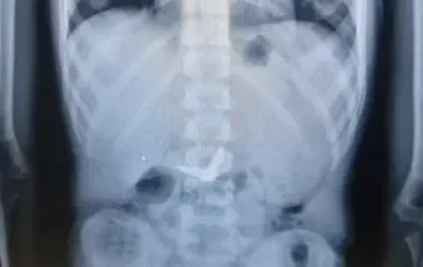 נס רפואי: ילד בן 11 בלע מספריים - והם נפלטו מגופו ללא כל ניתוח